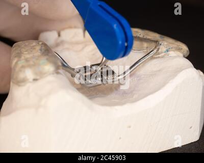 Détail du réglage des accolades. Bretelles Hyrax pour les dents du patient. Plâtre moulé du haut du palais des patients avec des anomalies congénitales de la te antérieure Banque D'Images