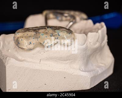 Modèle de mâchoire en gypse avec dispositif de retenue d'expansion amovible orthodontique. Outil dentaire, matériau acrylique sur acier inoxydable. Banque D'Images