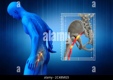 Nerf sciatique humain pincé, vision anatomique. illustration 3d. Banque D'Images