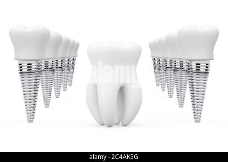 Dent saine prémolaire entre les rangées d'implants de dents sur un fond blanc. Rendu 3d Banque D'Images