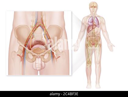 Stade IV cancer de la vessie chez l'homme, invasion tumorale avec métastases. L'illustration à droite du dessin représente l'anatomie générale en ma Banque D'Images