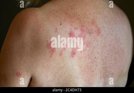 Femme souffrant de l'éruption de Shingles causée par le virus varicelle-zona Royaume-Uni photo prise par Simon Dack Banque D'Images