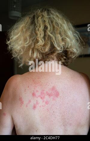 Femme souffrant de l'éruption de Shingles causée par le virus varicelle-zona Royaume-Uni photo prise par Simon Dack Banque D'Images