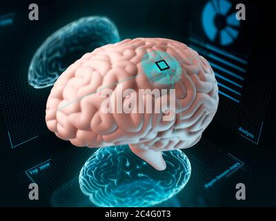 Puce implantée dans le cerveau humain, illustration. Banque D'Images