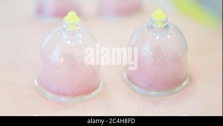 Hijama - le traitement de la saignée. Ventouse fixée. Banque D'Images