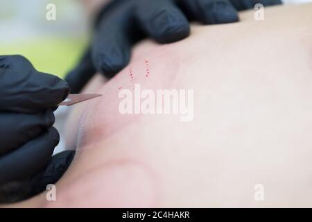 Hijama - le traitement de la saignée. Ventouse fixée. Processus de scarification. Banque D'Images