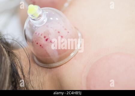 Hijama - le traitement de la saignée. Ventouse fixée. Processus de scarification. Banque D'Images