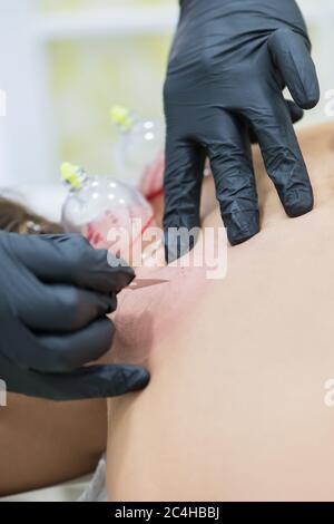 Hijama - le traitement de la saignée. Ventouse fixée. Processus de scarification. Banque D'Images