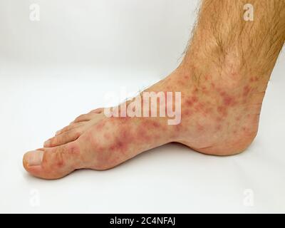 Gros plan du pied et des orteils de l'homme avec une éruption cutanée rouge desase sur fond blanc. Image de stock. Banque D'Images