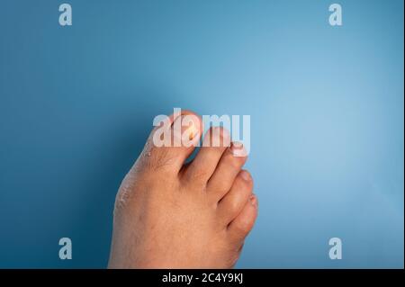 Gros plan une infection sur les ongles du pied de l'homme avec un champignon sur fond bleu. Banque D'Images