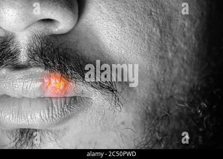 Gros plan de détail mâle caucasien barbu qui a souffert du virus de l'herpès simplex sur les lèvres. Composition en noir et blanc. Banque D'Images