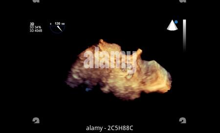 Image 3D du cœur pendant l'échographie transœsophagienne du cœur. Banque D'Images