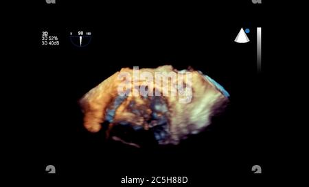 Image 3D du cœur pendant l'échographie transœsophagienne du cœur. Banque D'Images