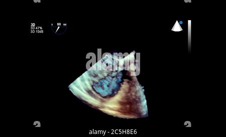 Image 3D du cœur pendant l'échographie transœsophagienne du cœur. Banque D'Images