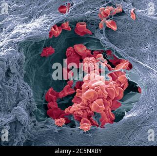 Vaisseau sanguin cutané. Micrographe électronique à balayage coloré (SEM) d'un vaisseau sanguin (artériole) dans le derme de la peau. Dans le vaisseau sanguin se trouvent les globules rouges (érythrocytes, rouges) qui transportent l'oxygène autour du corps. Certaines de ces globules rouges sont crénelées. Le vaisseau sanguin est entouré de tissu conjonctif qui donne à la peau son tonus et son élasticité. Agrandissement : 1000 lorsqu'il est imprimé à 10 centimètres de large. Banque D'Images