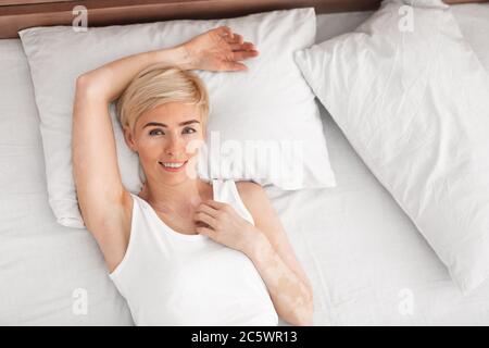 Femme gaie et mûre avec vitiligo couché dans le lit, vue du dessus Banque D'Images