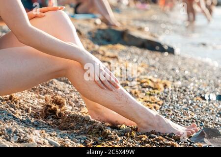Varicosité. La femme montre le maillage vasculaire sur la jambe inférieure. Jambes en gros plan. En arrière-plan la plage et la mer. Banque D'Images