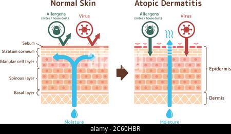 Vue en coupe de la dermatite atopique et peau normale / illustration vectorielle comparative Illustration de Vecteur