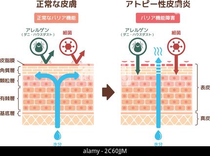 Vue en coupe de la dermatite atopique et de la peau normale / illustration vectorielle comparative (japonais) Illustration de Vecteur