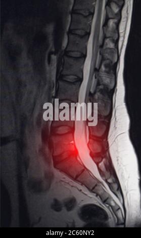 Image après examen de l'imagerie par résonance magnétique. Concept d'examen du rachis, otséochondrose, hernie intervertébrale lombaire Banque D'Images