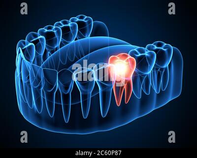 rendu 3d des rayons x de la mâchoire avec dent molaire de caching. Concept de mal de dents. Banque D'Images