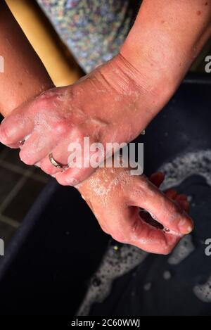 FRSM, masque porté par un employé du NHS, également une série de photos vous montrant la bonne façon de vous laver les mains dans la lutte contre le coronavirus, Covid-19 Banque D'Images