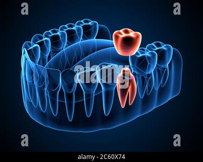 rendu 3d des rayons x de la mâchoire avec couronne dentaire intégrée à la dent refaçée Banque D'Images