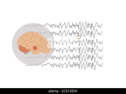 Illustration vectorielle du cerveau humain et des ondes cérébrales anormales représentant une crise focale dans le lobe temporal Illustration de Vecteur