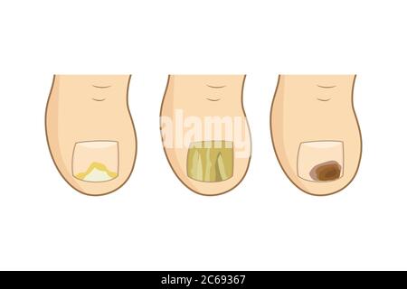 Types de mycoses de toénail. Illustration vectorielle. Ongles d'orteil santé, sentir champignon, soins du corps Illustration de Vecteur