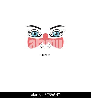 Lupus érythémateux disséminé. Femme avec un point rouge sur son visage en forme de papillon. Illustration vectorielle Illustration de Vecteur