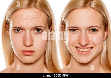 Portrait comparatif du visage féminin, avant et après le traitement cosmétique Banque D'Images