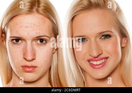 Portrait comparatif du visage féminin, avant et après le traitement cosmétique Banque D'Images