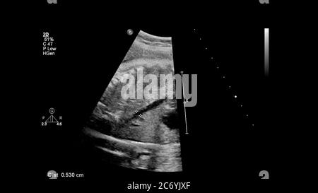 Ecran d'échographie avec échocardiographie fœtale. Banque D'Images