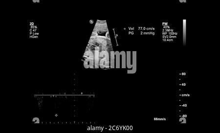 Ecran d'échographie avec échocardiographie fœtale. Banque D'Images