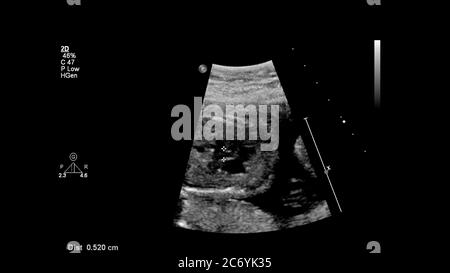 Ecran d'échographie avec échocardiographie fœtale. Banque D'Images