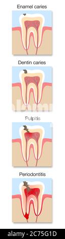 Infographie sur le développement des caries, stades avec une section transversale de caries dentaires avec émail et dentine, pulpite et parodontite. Banque D'Images