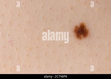 Photo macro de marque de naissance de mole nevus sur la peau humaine. Gros plan. Banque D'Images