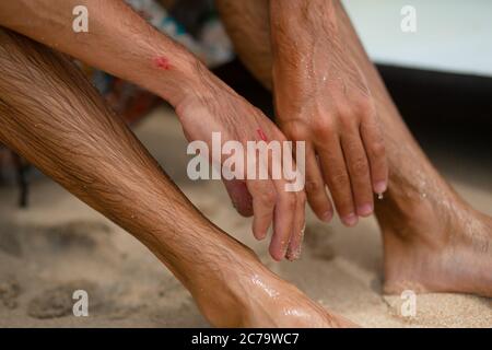 Le gars a eu des abrasions après une chute infructueuse du surf. Un gars mouillé sur la rive examine un bras blessé Banque D'Images