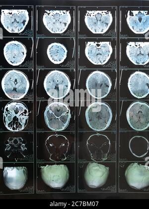 IRM du cerveau humain après un traumatisme crânien. Photo de haute qualité Banque D'Images