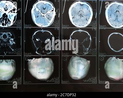 Cette photo montre une IRM du cerveau par résonance magnétique après une lésion cérébrale traumatique, montrant que le cerveau est endommagé Banque D'Images