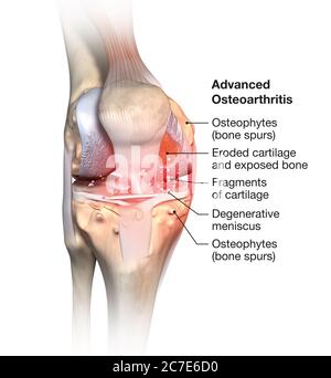 Illustration montrant une articulation ostéoarthritique avancée douloureuse du genou Banque D'Images