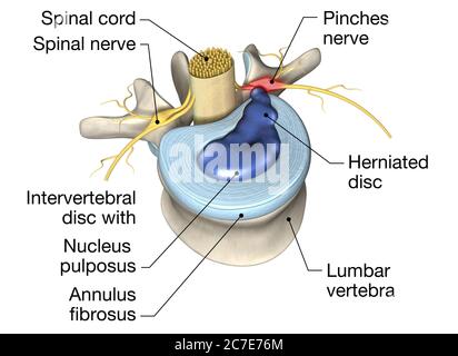 Illustration tridimensionnelle montrant un disque hernié douloureux ou un disque glissé Banque D'Images
