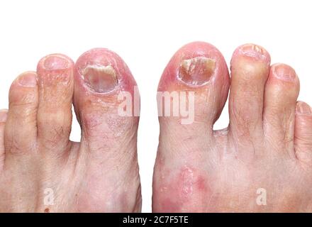 Un cas modéré à grave d'athlètes pied (tinea pedis) affectant la peau du pied et des orteils. Également montrant le champignon de la crapaule. Isolé, Banque D'Images