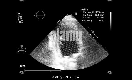 Image du cœur en mode échelle de gris pendant l'échographie transœsophagienne. Banque D'Images
