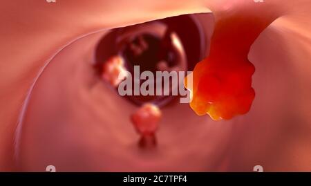 Vue rapprochée des polypes intestinaux et des tissus intestinaux malades pouvant causer le cancer - illustration 3d Banque D'Images
