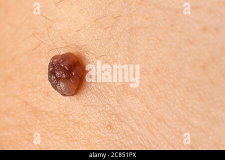 Photo macro de marque de naissance de mole nevus sur la peau humaine. Gros plan Banque D'Images