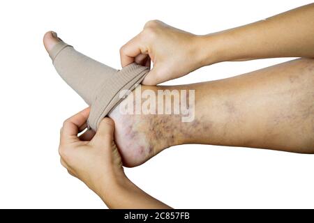 une femme met un bas de contention sur sa jambe avec des varices. Prévention varices, collants de compression, soulagement pour les jambes fatiguées. Jambes de femmes Banque D'Images