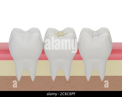 Dents avec de l'or, amalgame et garniture dentaire composite, trois dents molaires dans la gomme. Différents types de remplissage, rendu 3d Banque D'Images