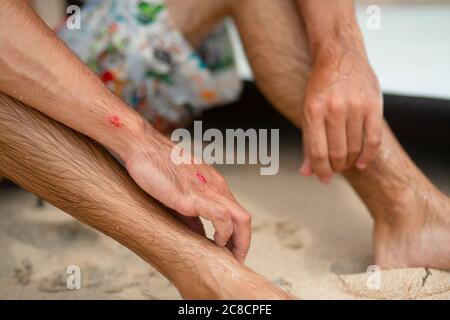 Le gars a eu des abrasions après une chute infructueuse du surf. Un gars mouillé sur la rive examine un bras blessé Banque D'Images
