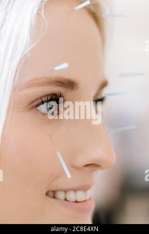 Acupuncture, jeune femme avec aiguille d'acupuncture pendant le traitement dans le visage Banque D'Images